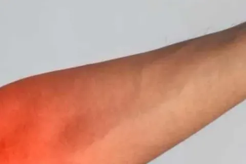 Tennis Elbow vs. Golfer's Elbow: How to Tell the Difference