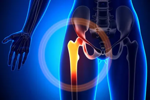 5 Clear Signs That You Need a Hip Joint Replacement