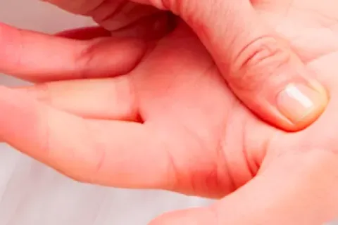 Flexor Tendon Injuries: Causes, Symptoms, and Treatment