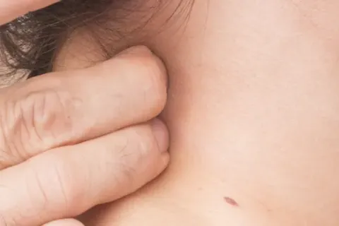 What is Cervical Radiculopathy?