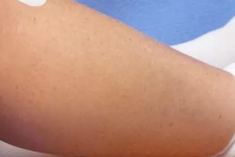 Overcoming Knee Replacement Stiffness: Causes and Remedies