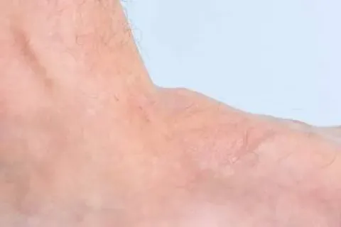 Managing Flatfoot and Arch Pain