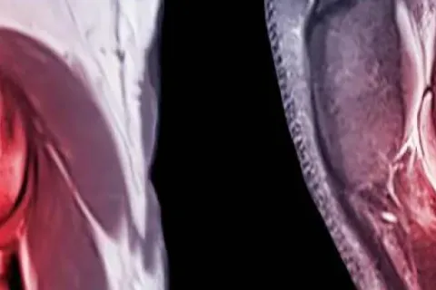 Anterior Cruciate Ligament (ACL) Tears and Treatment Options