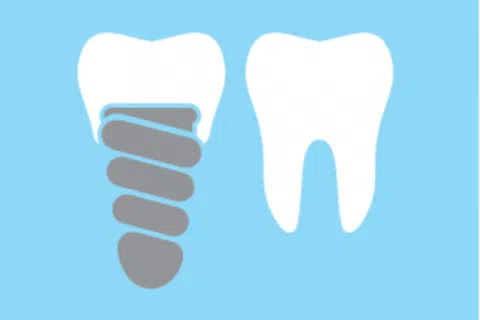 Learning The Lingo – Dental Implants