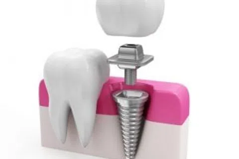 Dental Implants: High Tech Teeth