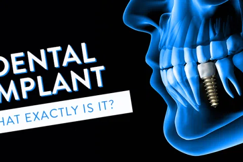 What Exactly Is A Dental Implant?
