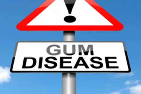 Gum Disease: Locating A Silent Adversary