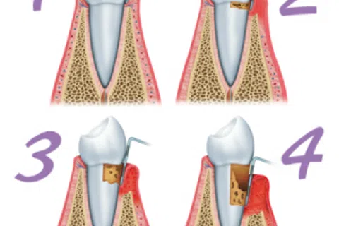 10 Tips To Prevent Gum Disease