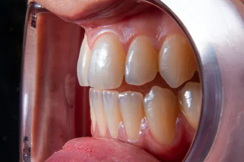 Close-up side view of upper and lower teeth with dental cheek retractor showing natural tooth color and gums