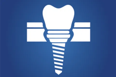 Dental Implants: FAQ