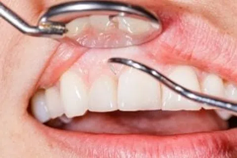 5 Facts About Gums