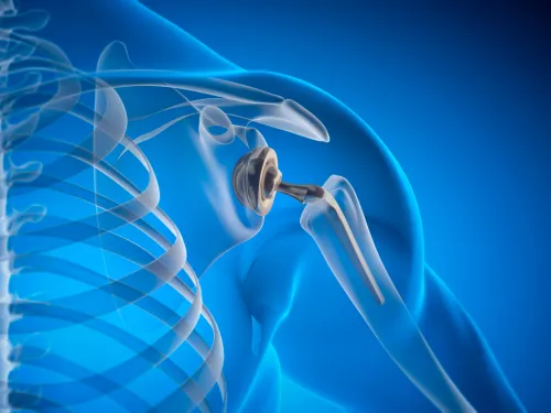 3D medical illustration of a shoulder joint with a prosthetic implant