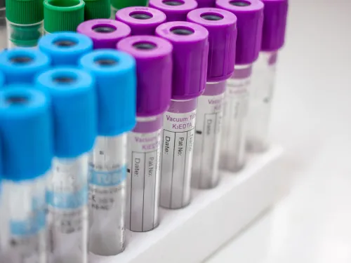Lab test tubes with blue, green, and purple caps arranged in a white rack, labeled for medical analysis.