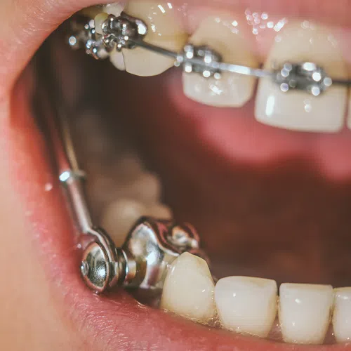 Close-up of teeth with braces and orthodontic headgear inside an open mouth.