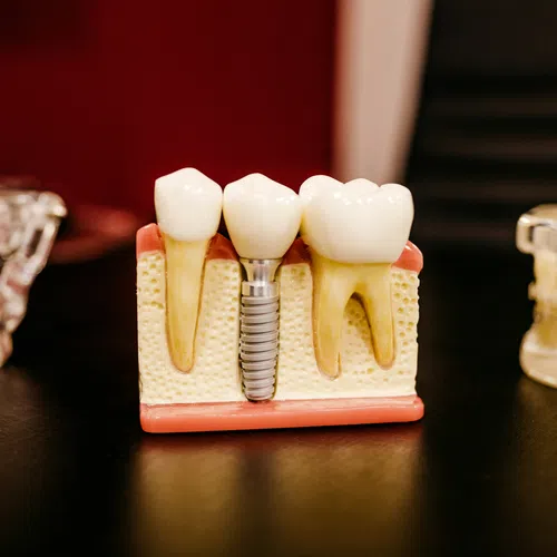 Dental model showing natural teeth and a metal dental implant embedded in gum and bone tissue.