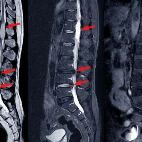 MRI scan of the spinal column with red arrows indicating disc abnormalities or herniations.
