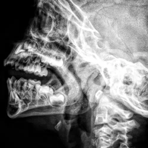 Close-up X-ray image showing human skull, jaw, teeth, and cervical spine in profile view with detailed bone structure.