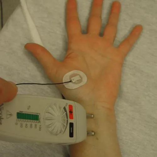 Close up of an EMG being performed with a nerve conduction study