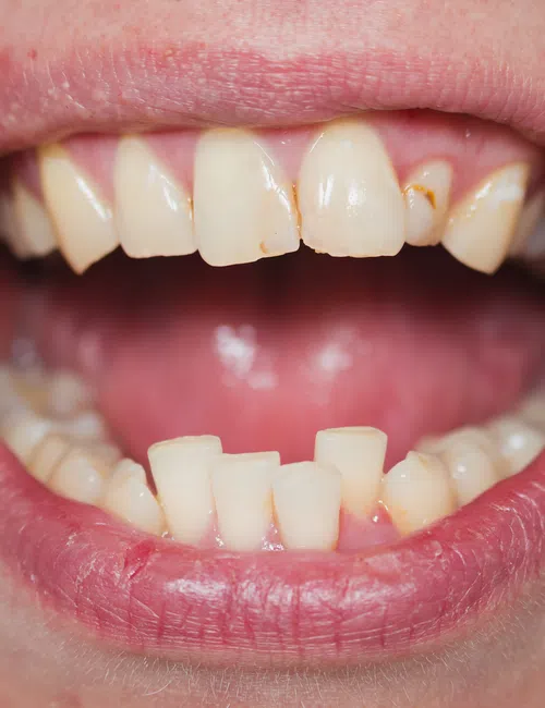 Close-up of an open mouth showing crooked, chipped, and yellowed teeth with visible dental plaque.