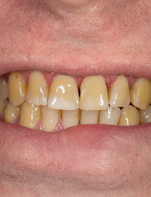 Close-up of a mouth showing stained and misaligned yellow teeth with some plaque buildup.