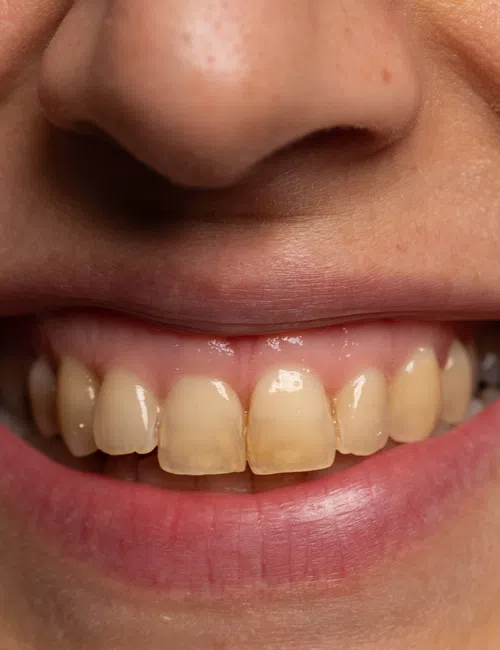 Close-up of a smiling mouth with slightly yellowed upper front teeth and healthy gums.