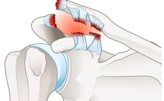 AC Joint Separation Salem, OR  Shoulder Joint Separation Springfield, OR