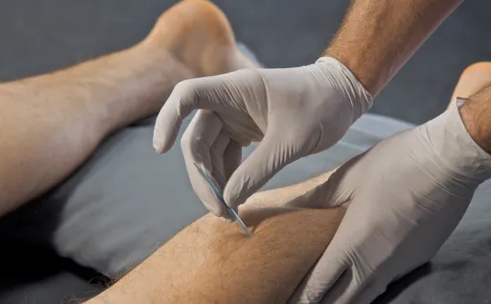 dry needling of calf lower leg