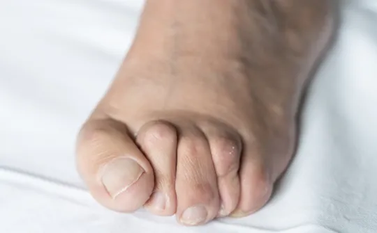 Hammer Toe Correction Surgery  Orthopaedic Specialists of Austin