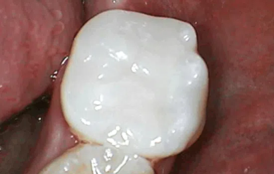 Close-up of a white dental filling on a molar tooth inside the mouth.