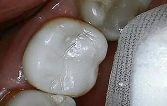 Close-up of a molar tooth with dental filling next to a white textured cloth inside a mouth.