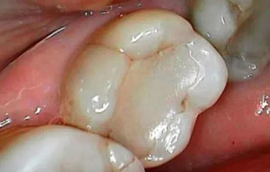 Close-up of a healthy molar tooth in the lower jaw surrounded by pink gums and adjacent teeth.