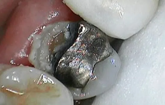 Close-up of a tooth with a damaged silver dental filling and surrounding teeth.