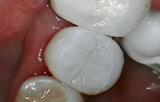 Close-up of a healthy molar tooth with a smooth white surface and surrounding pink gum tissue.