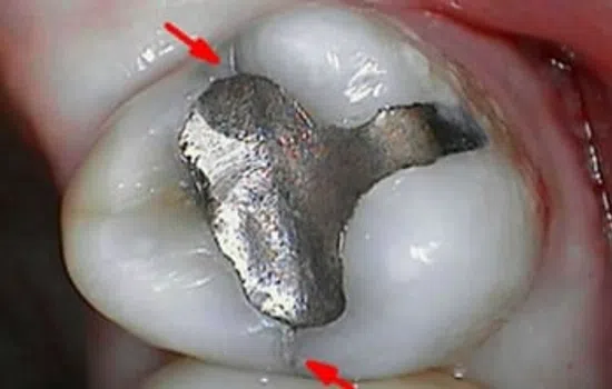Close-up of a molar tooth with a silver dental filling and red arrows pointing to its edges.