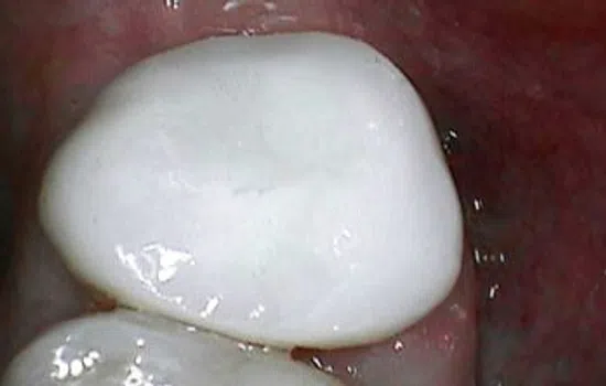 Close-up of white tooth crown inside the mouth with surrounding pink gum tissue visible.