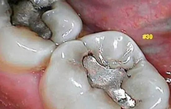 Close-up of molar tooth with silver dental filling and surrounding gum tissue.