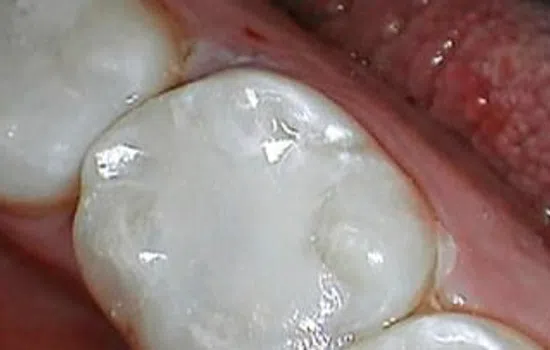 Close-up of healthy molar teeth with smooth white enamel and surrounding pink gum tissue.