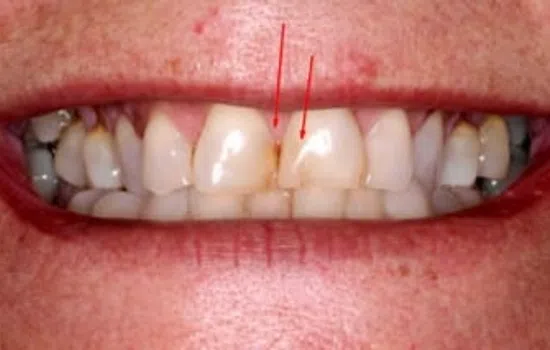 Close-up of a smile showing stained and misaligned teeth with red arrows pointing at specific teeth.