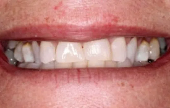 Close-up of a person's mouth showing teeth with visible discoloration and dental issues.