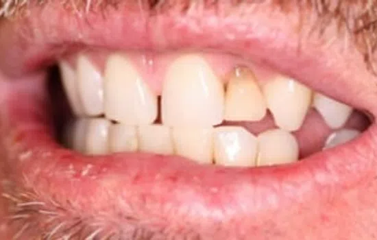 Close-up of a mouth with crooked, discolored, and missing teeth showing dental issues.