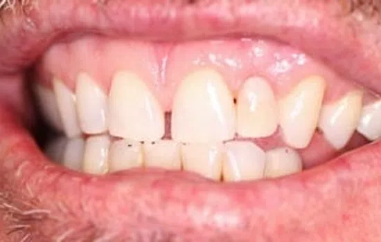 Close-up of a person's mouth showing uneven teeth with gaps and discoloration on the front teeth.