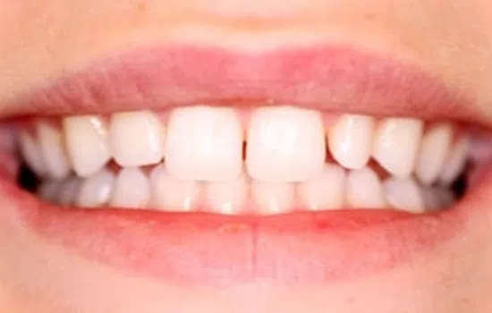 Close-up of a smiling mouth showing white teeth and natural pink lips with slight gaps between teeth.