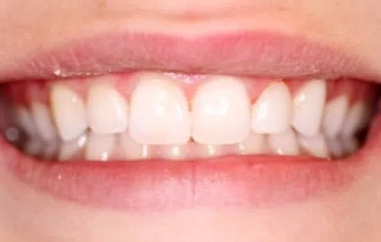 Close-up of a smiling mouth showing clean white teeth and healthy pink lips.