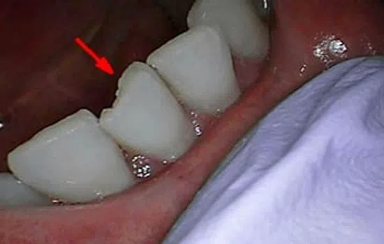 Close-up of lower teeth showing a chipped tooth indicated by a red arrow inside the mouth.