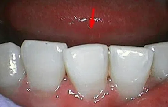 Close-up of upper front teeth with a small red arrow pointing at a minor defect on the central tooth.