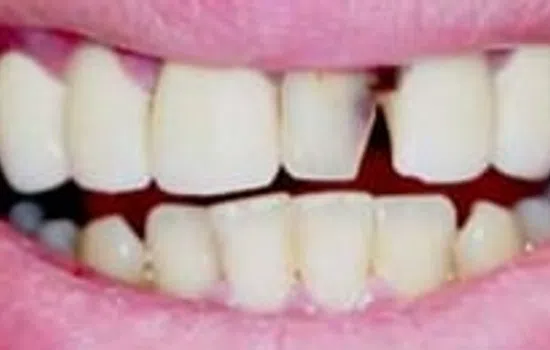 Close-up of teeth with a noticeable gap and uneven spacing between upper front teeth and lower teeth.