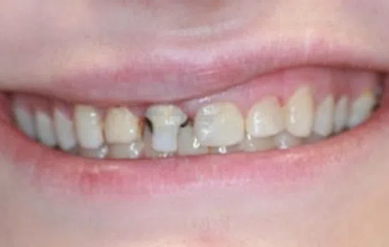 Close-up of a smile showing teeth with visible dental decay and cavities on front teeth.