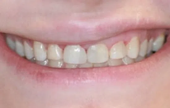 Close-up of a smiling mouth showing natural, slightly uneven teeth with healthy pink lips.