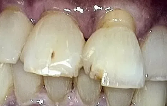 Close-up of upper front teeth with visible decay, discoloration, and chipping on several teeth.