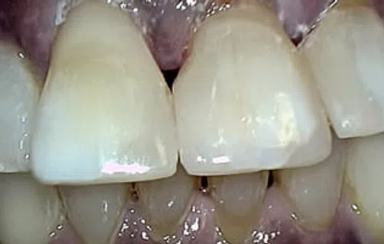 Close-up of human teeth showing front upper and lower incisors with some discoloration and plaque buildup.